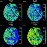 Basics of CT Brain Perfusion